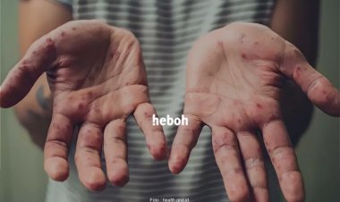 Pasien Pertama Cacar Monyet Resmi Terkonfirmasi di DKI Jakarta, Pria 27 Tahun